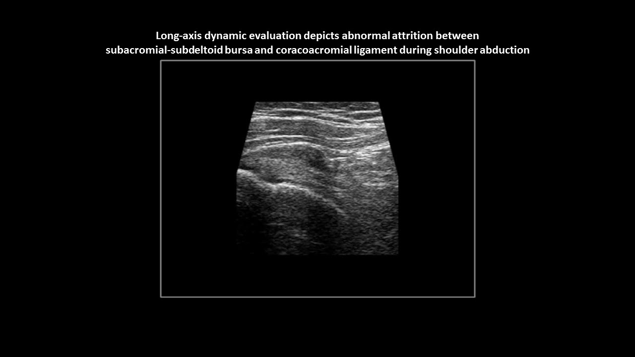 Subacromial impingement on dynamic real-time shoulder ultrasound (case 4)