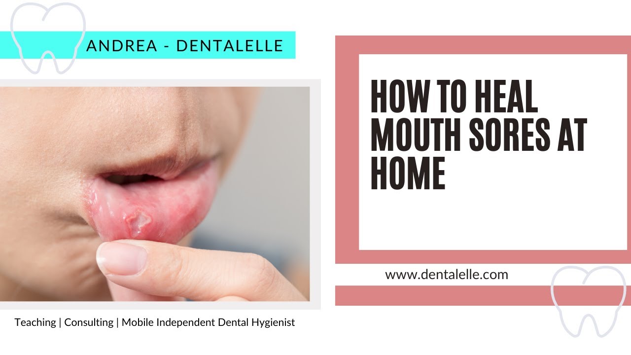 How To Heal Mouth Sores at Home QUICKLY (by an RRDH)