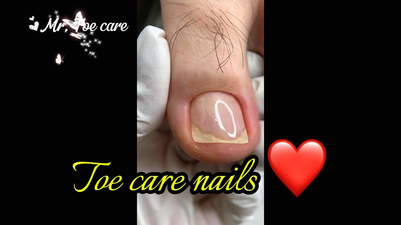 Toe care fix! 👍#nails #shiningnails #naildesign #nailart #nailtutorial #naildecoration 