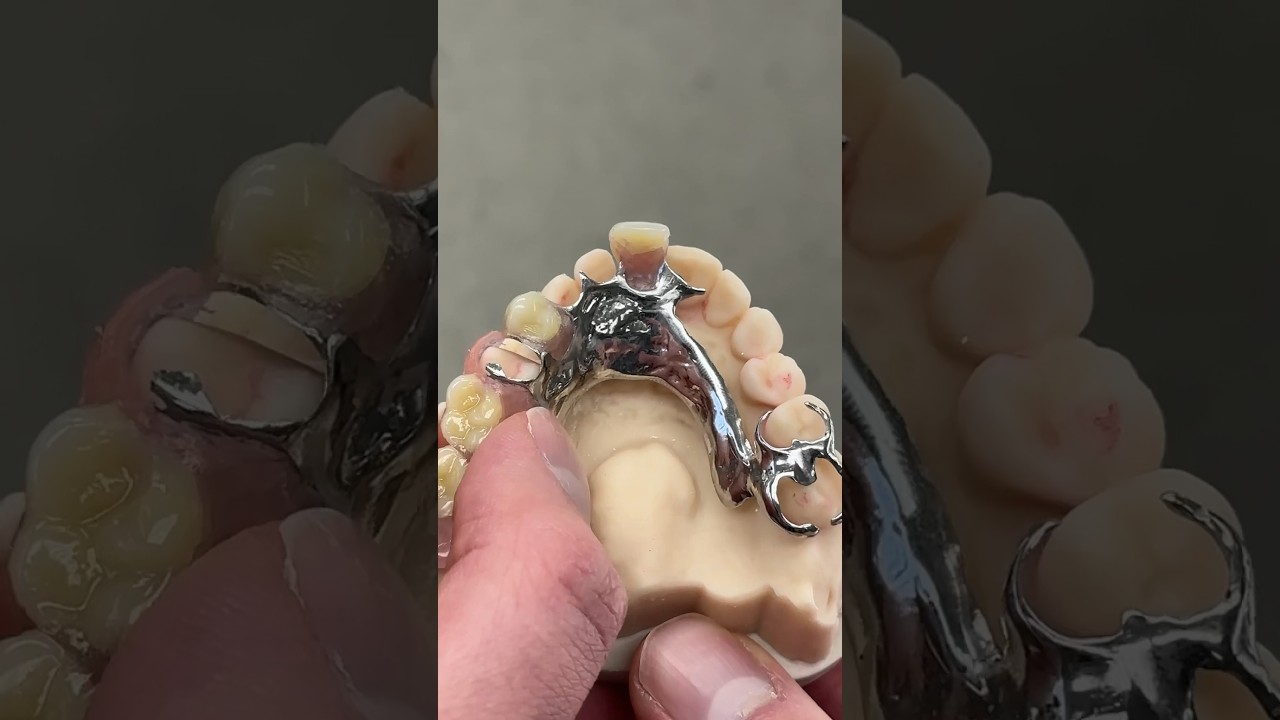 Cast Metal Partial @EnvisiontecMain #envisiontec #dental #teeth #smile #shorts #lsk121shorts