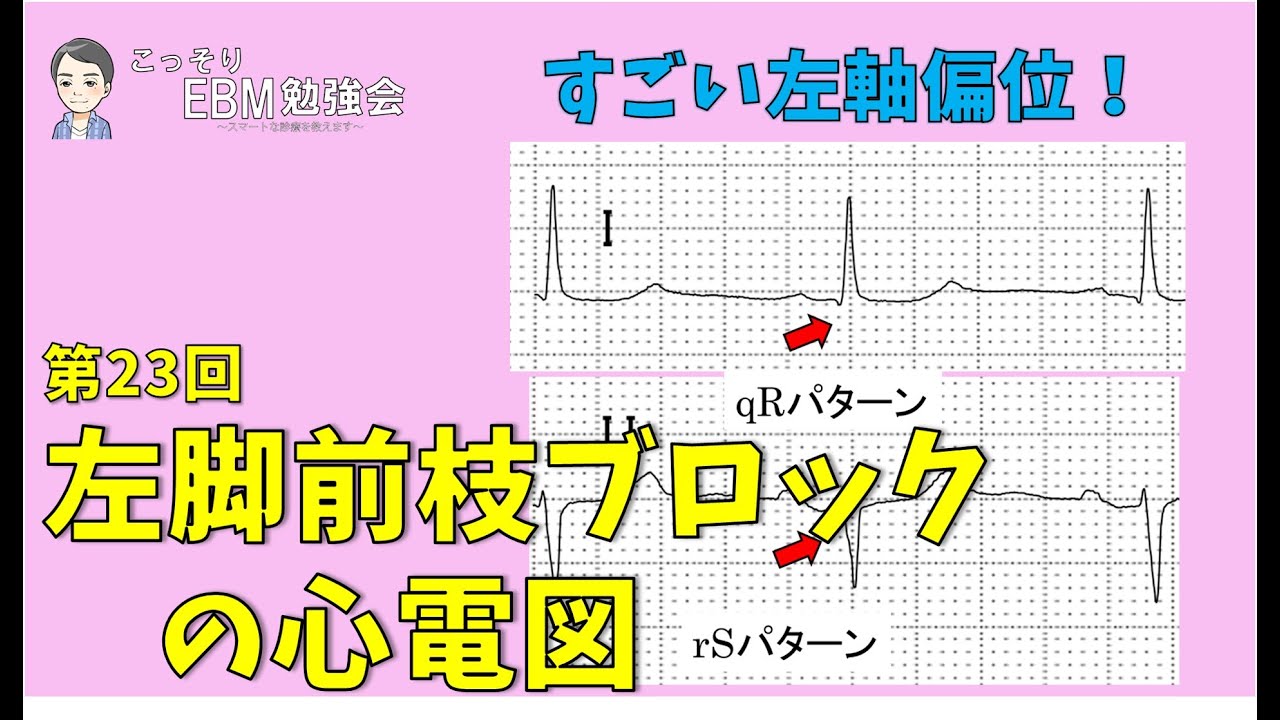 【心電図】第23回　分かる！左脚前枝ブロックの心電図