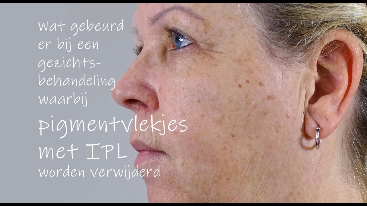 IPL gezichtsbehandeling pigmentvlekken