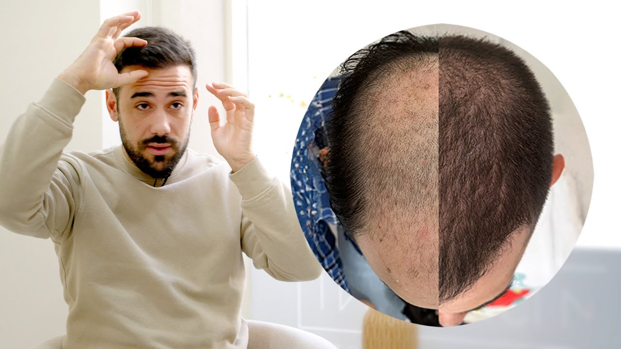 “El resultado al tratar mi alopecia ha sido brutal.” | Testimonio real