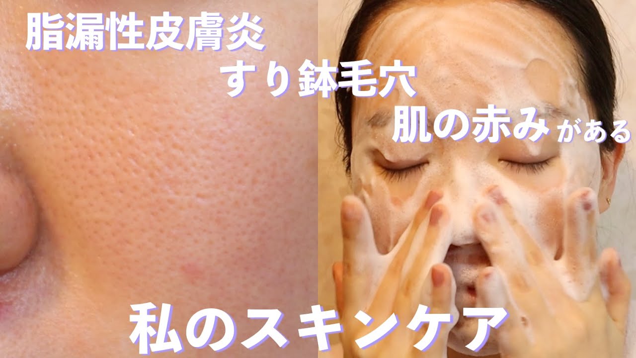 脂漏性皮膚炎（酒さと診断されました）、すり鉢毛穴、ニキビ肌の私のスキンケア(肌の赤みが改善したスキンケア商品をご紹介します) 開き毛穴、いちご鼻、角栓