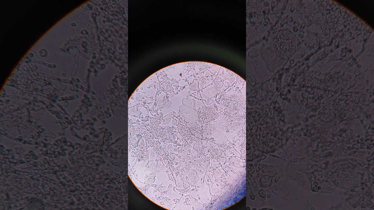 Budding yeast cells under microscope | Urine infection | 