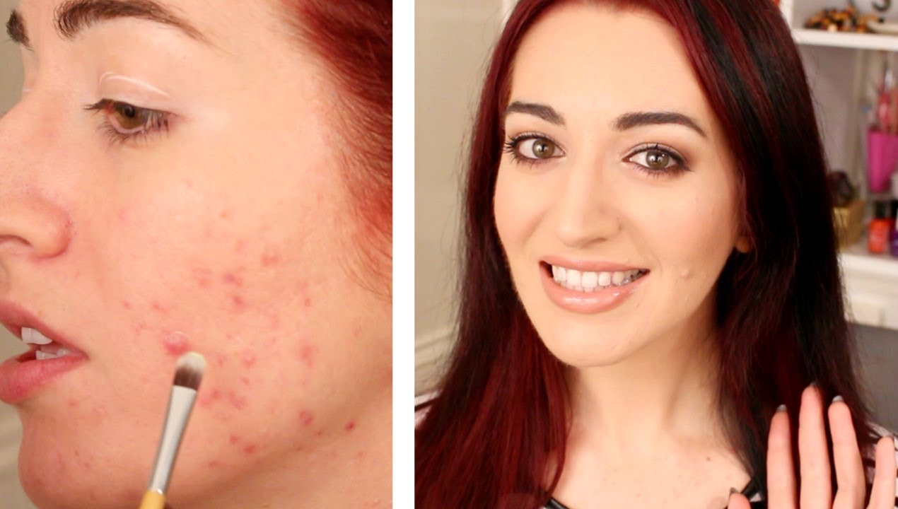How To Cover A Pimple With Green Concealer (My Step-By-Step Guide)