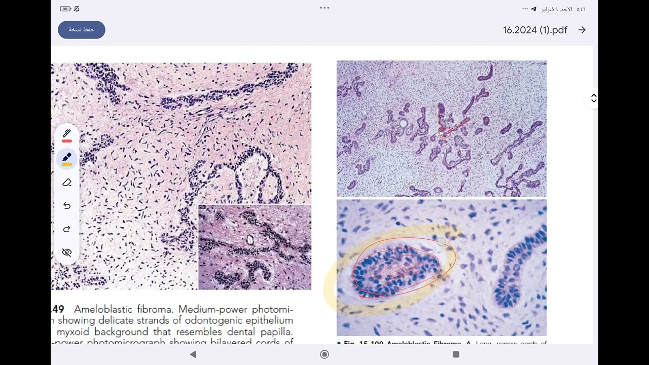 oral pathology odontogenic tumor part 2 مرحلة رابعة طب أسنان