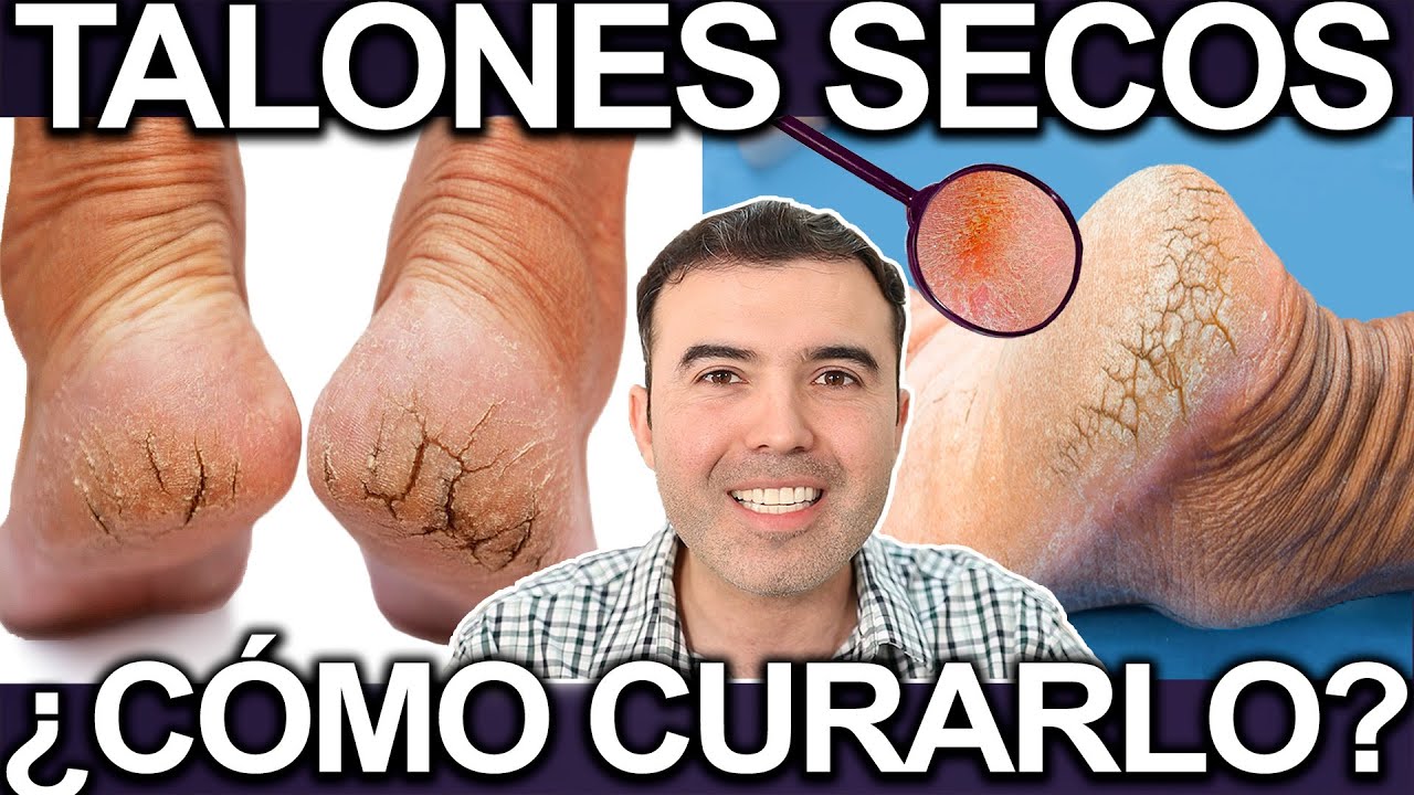 COMO CURAR LOS TALONES SECOS Y AGRIETADOS - Regenera La Piel De Tu Talon Y Elimina Los Callos