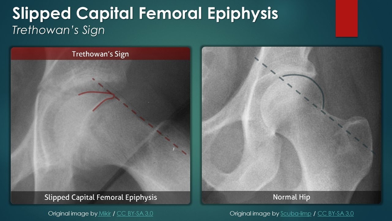 Slipped Capital Femoral Epiphysis: Plain Radiography