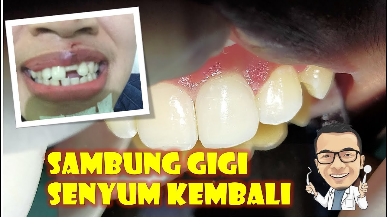 Sambung gigi depan patah akibat kecelakaan (proses dan biaya)