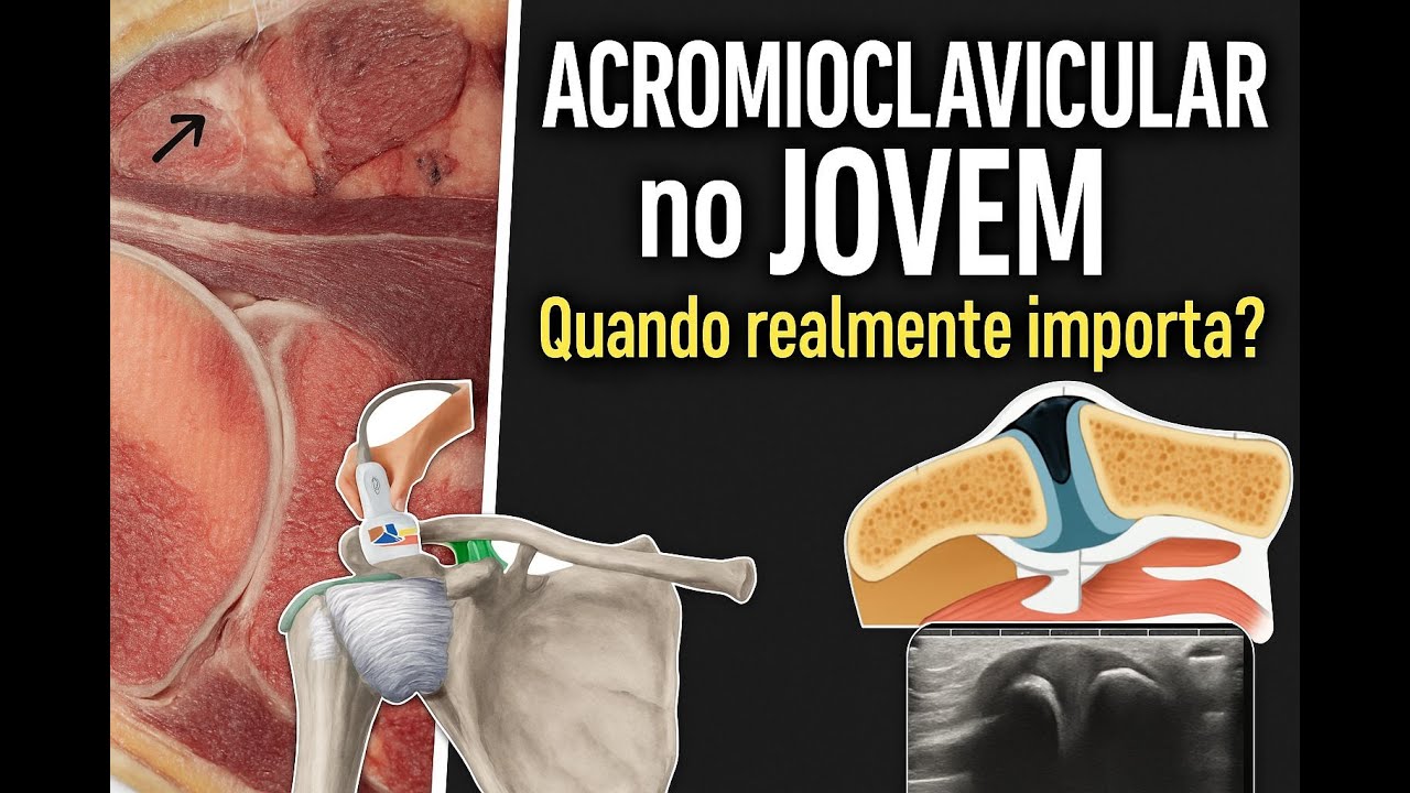 Alterações da Acromioclavicular no Jovem: Quando REALMENTE Importam?