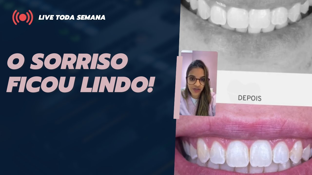 Caso clínico de Mallu (gengivoplastia e ortodontia) | Live toda semana #36