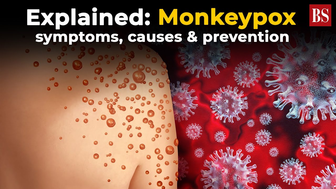 Explained: Monkeypox symptoms, causes & prevention