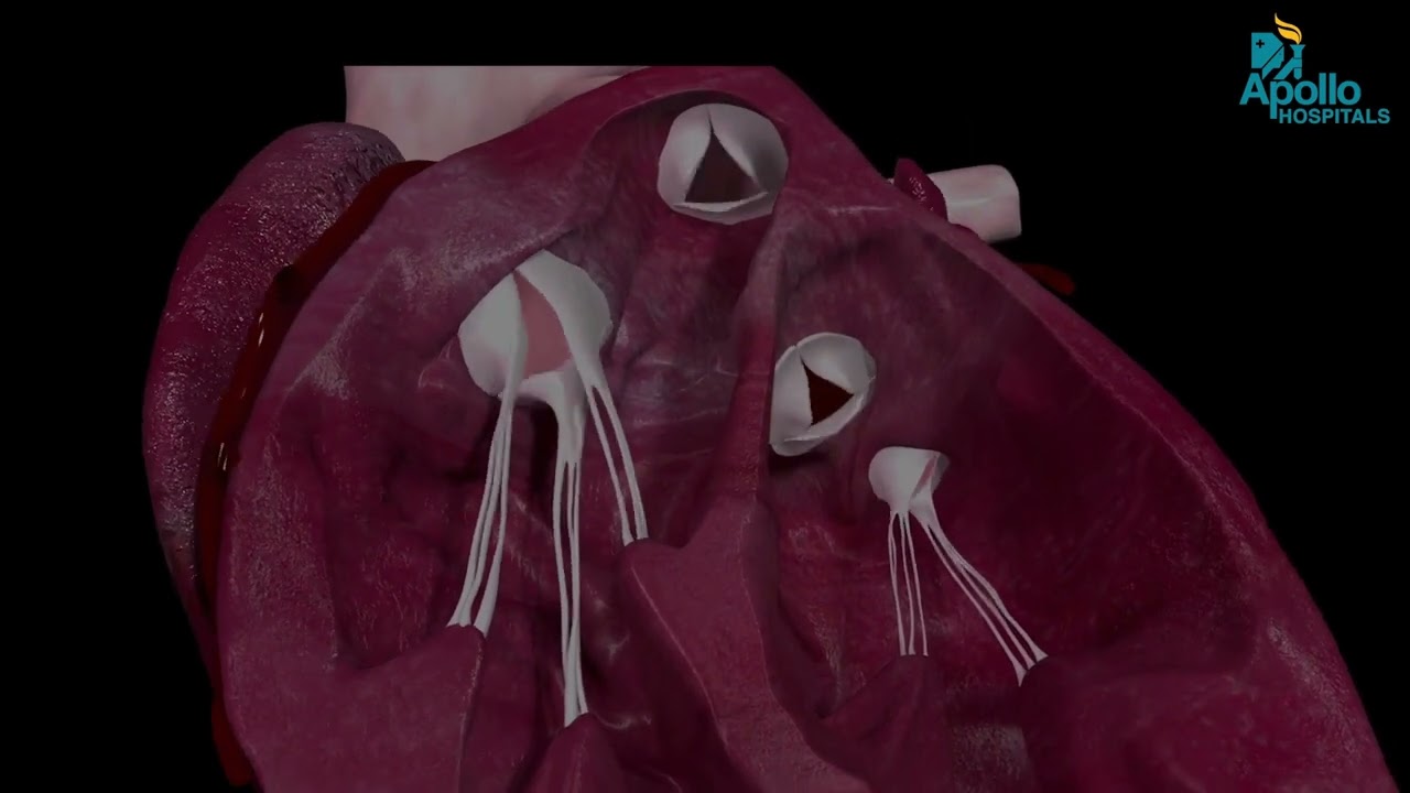 What Is Heart Valve Repair? | Doctor Explains Simply