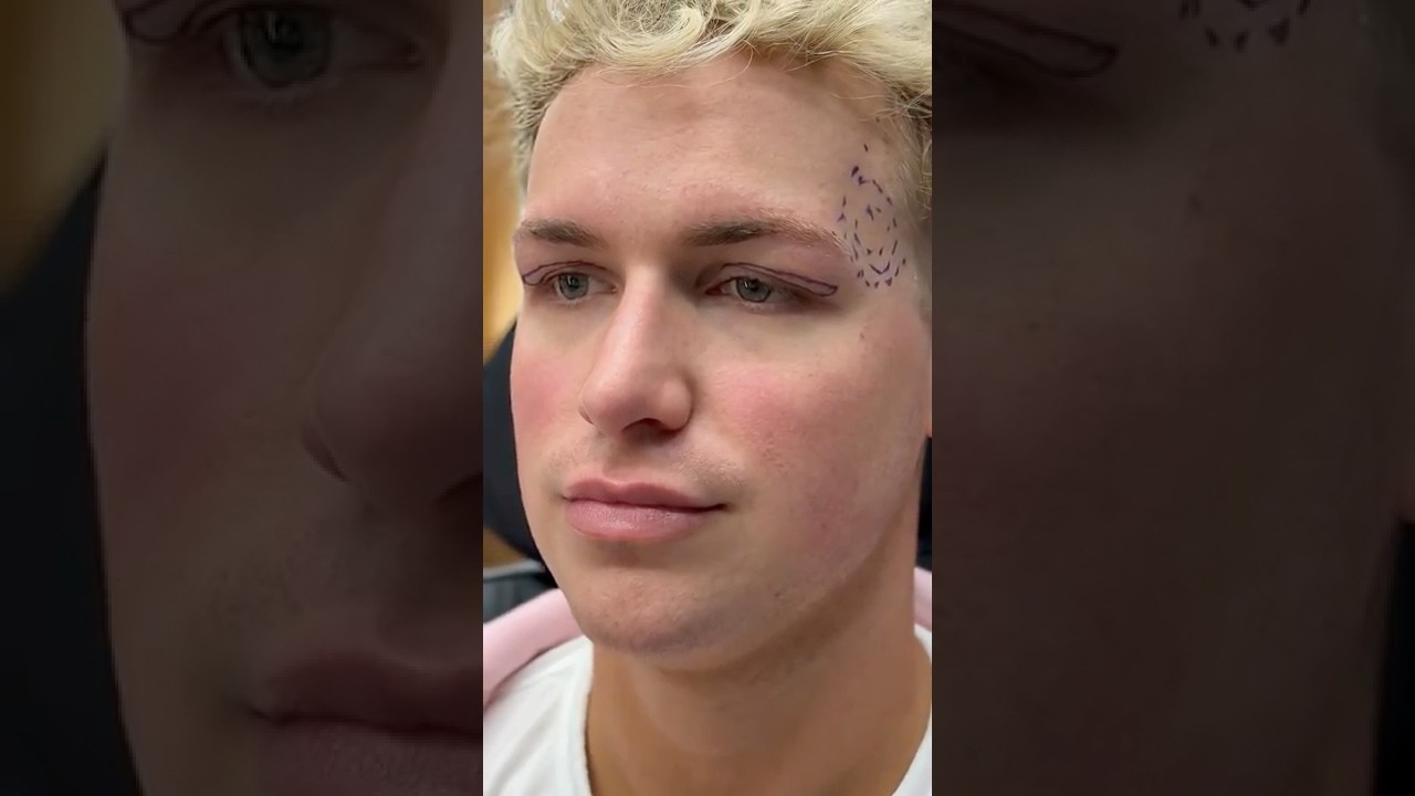 Male Upper Blepharoplasty for Hooded Eyelids & Fat Transfer to Temples | Dr. Jalalabadi