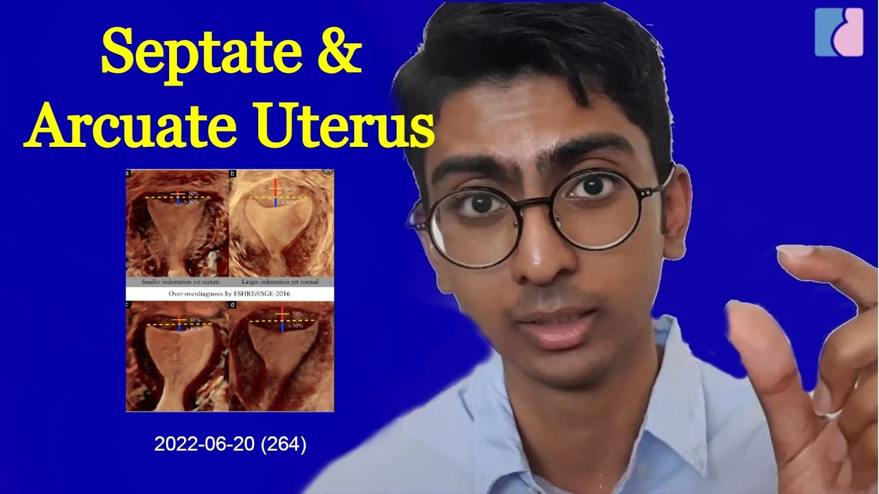 Septate & Arcuate Uterus: Emphasis on Treatment - Antai Hospitals