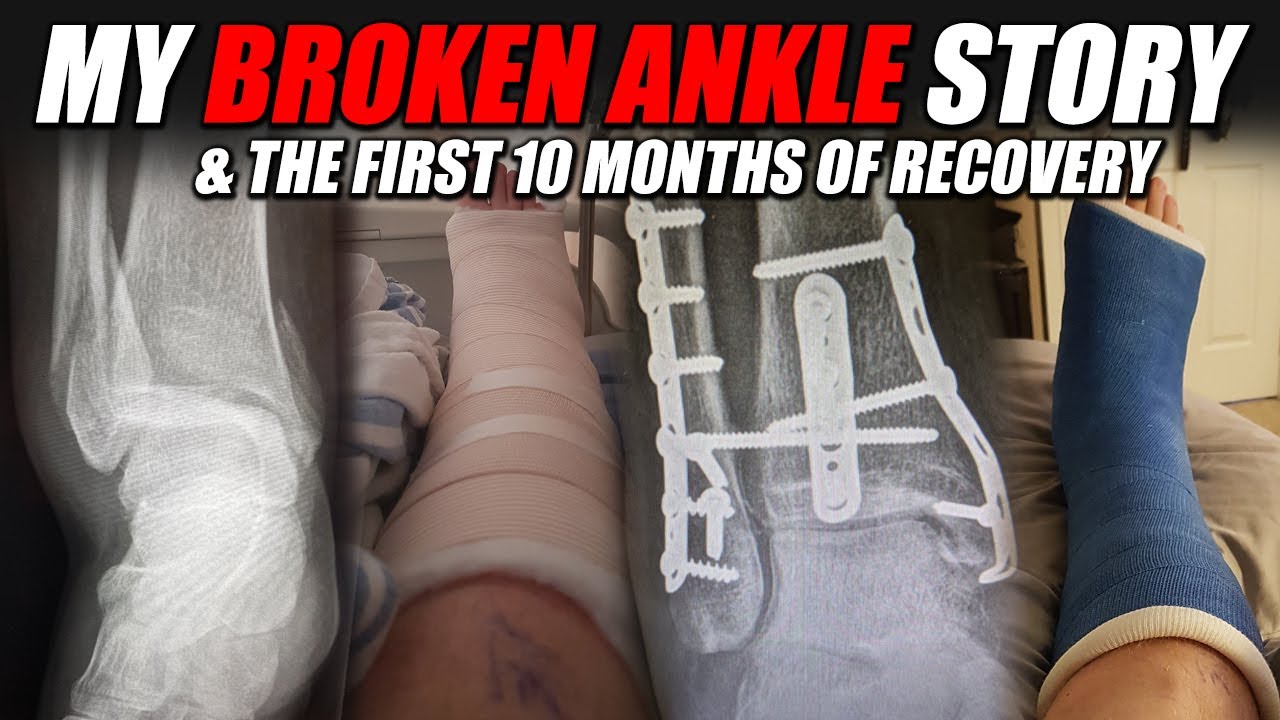 My Broken Ankle Story (Trimaleollar Fracture)