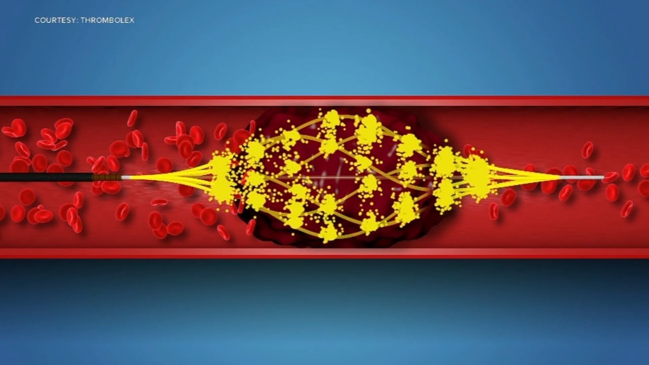 AI, new clot-busters enable faster blood clot care | Moves in Medicine