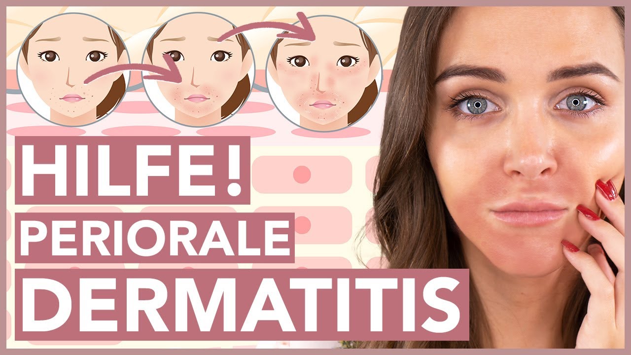 Periorale Dermatitis – So wirst Du sie los!