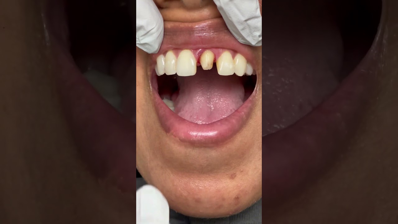 Amazing Invisible Dentistry with a Front Crown .... Perfect Match 😊