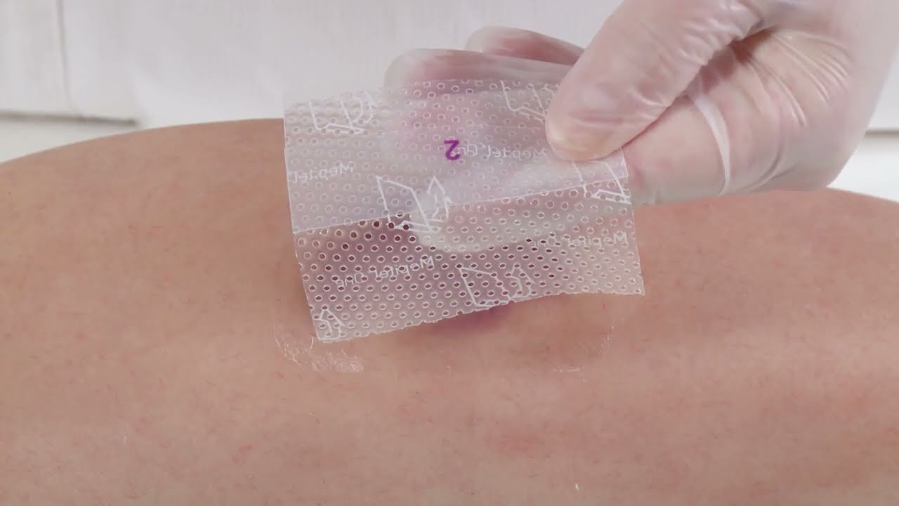 Curativo Mepitel One de Silicone Molnlycke - Compre na Vitae Saúde