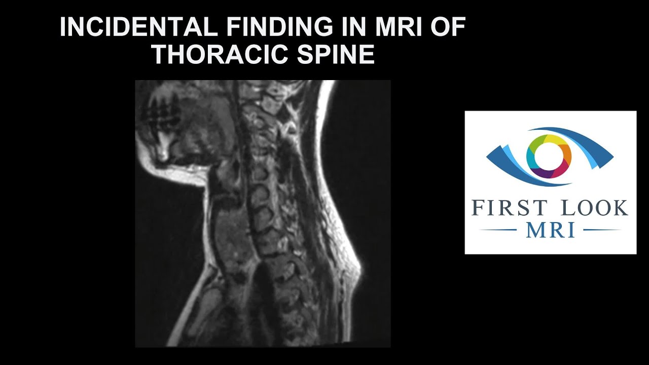Incidental finding in MRI of thoracic spine