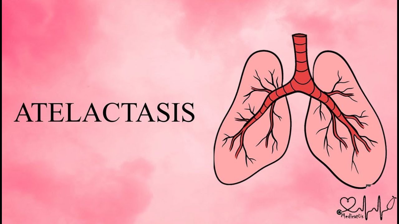 ATELECTASIS - types and causes
