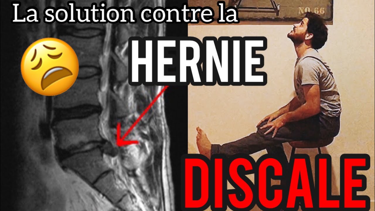 La ( VRAIE) solution pour la hernie discale ( KINÉ)