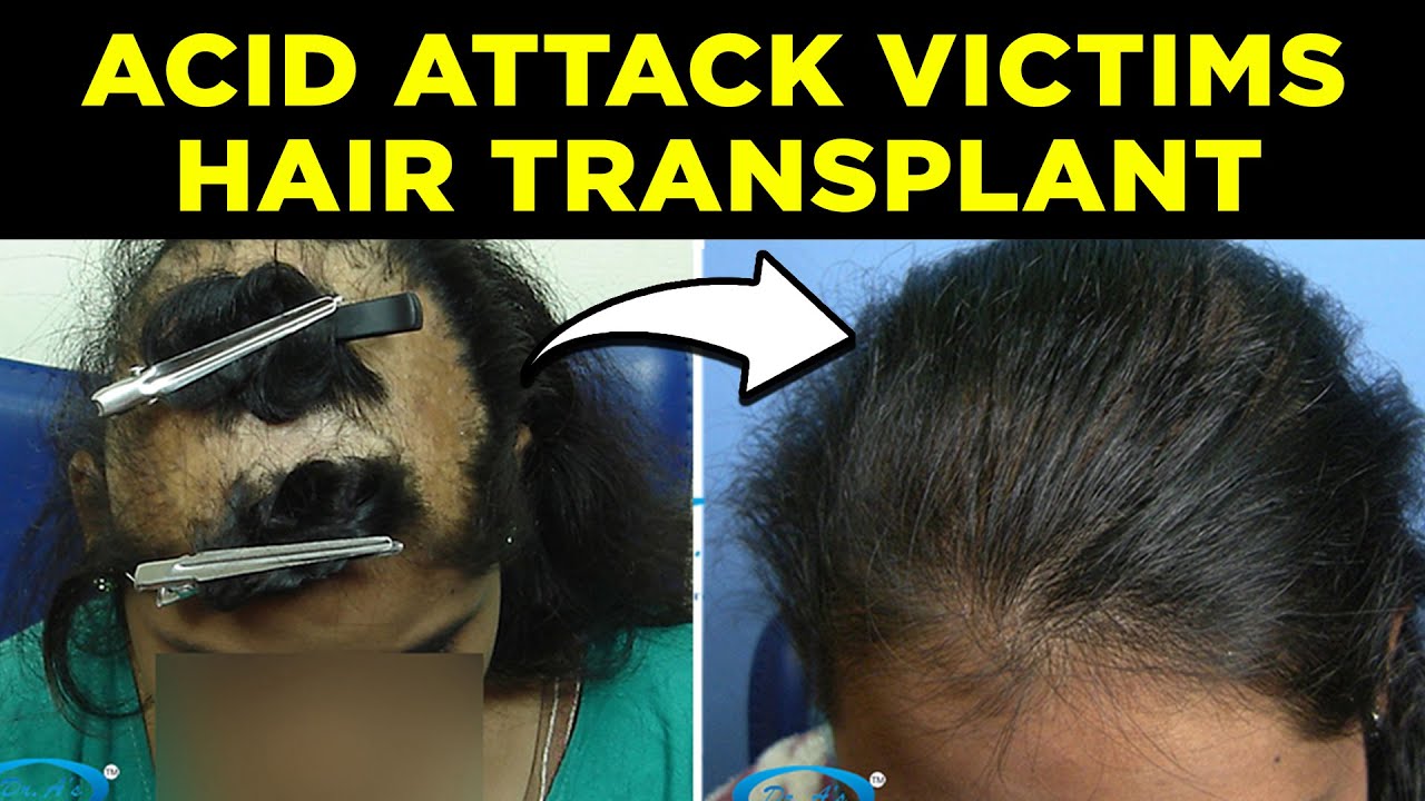 ✅ All About Surgery Scars | Acid attack victim & Burn Scars | By Dr Arvind Poswal✅