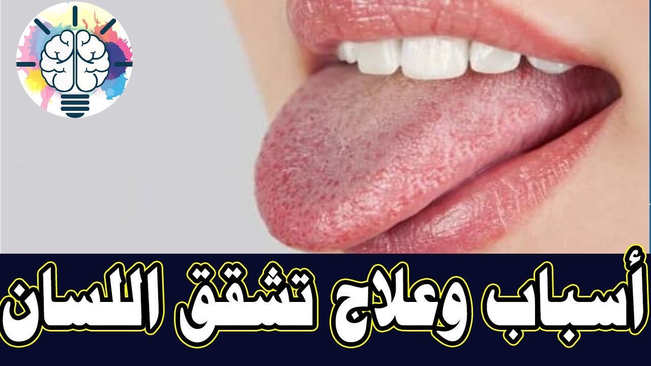 أسباب وعلاج تشقق اللسان
