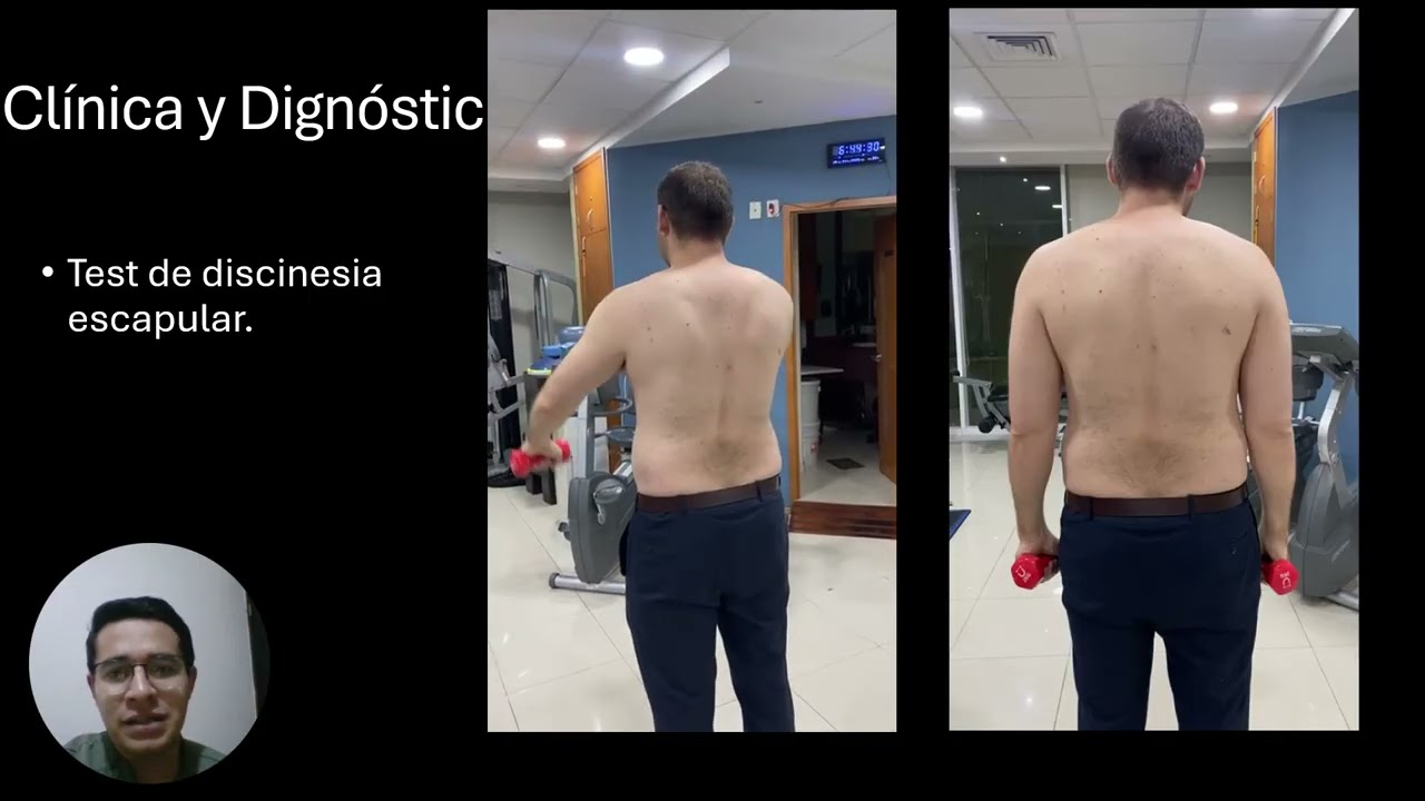 Discinesia Escapular