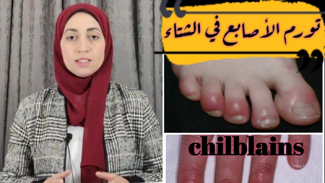 علاج تورم الأصابع في فصل الشتاء في خطوتين 👌🏻💯
