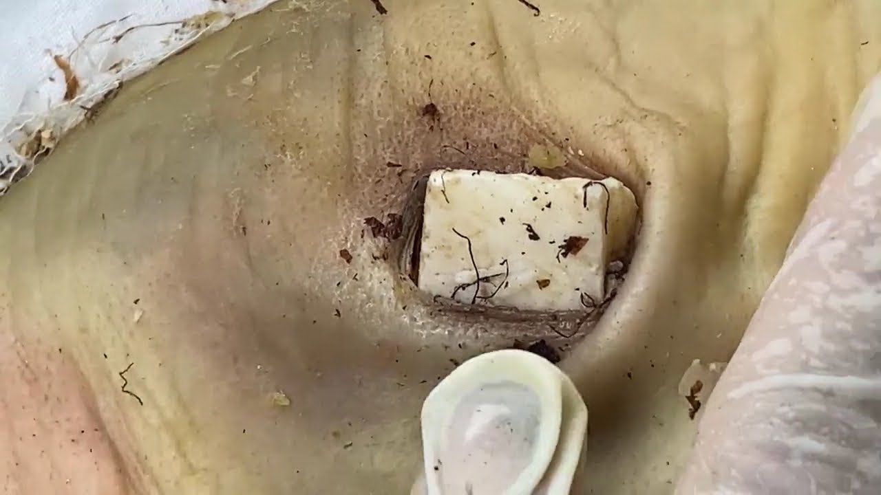 Boogerswax extraction | Boogers ear wax removal | Booger abscess drainage | Ear candle wax removals