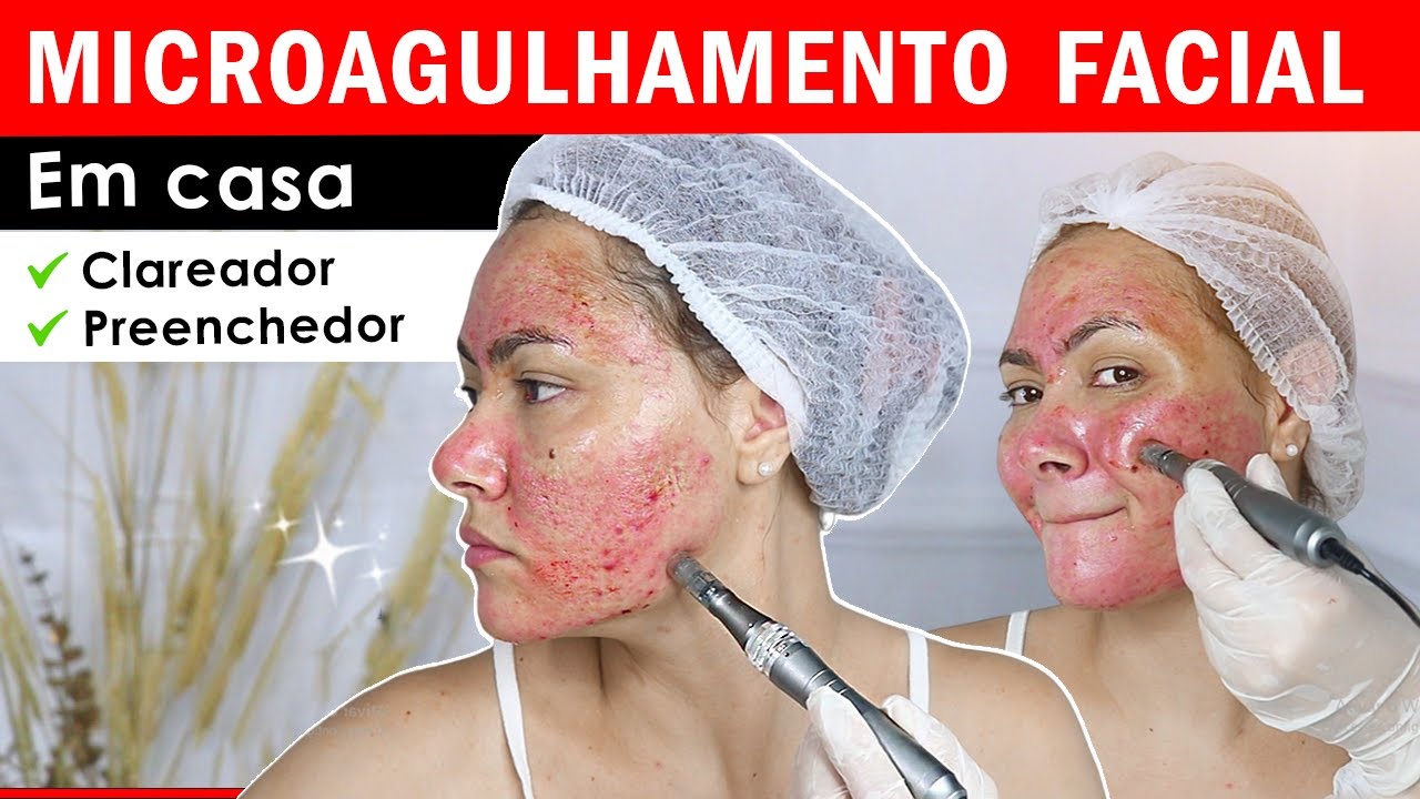 🩸MICROAGULHAMENTO como eu faço em casa - Resultado de Antes e depois  #microagulhamento #dermaroller
