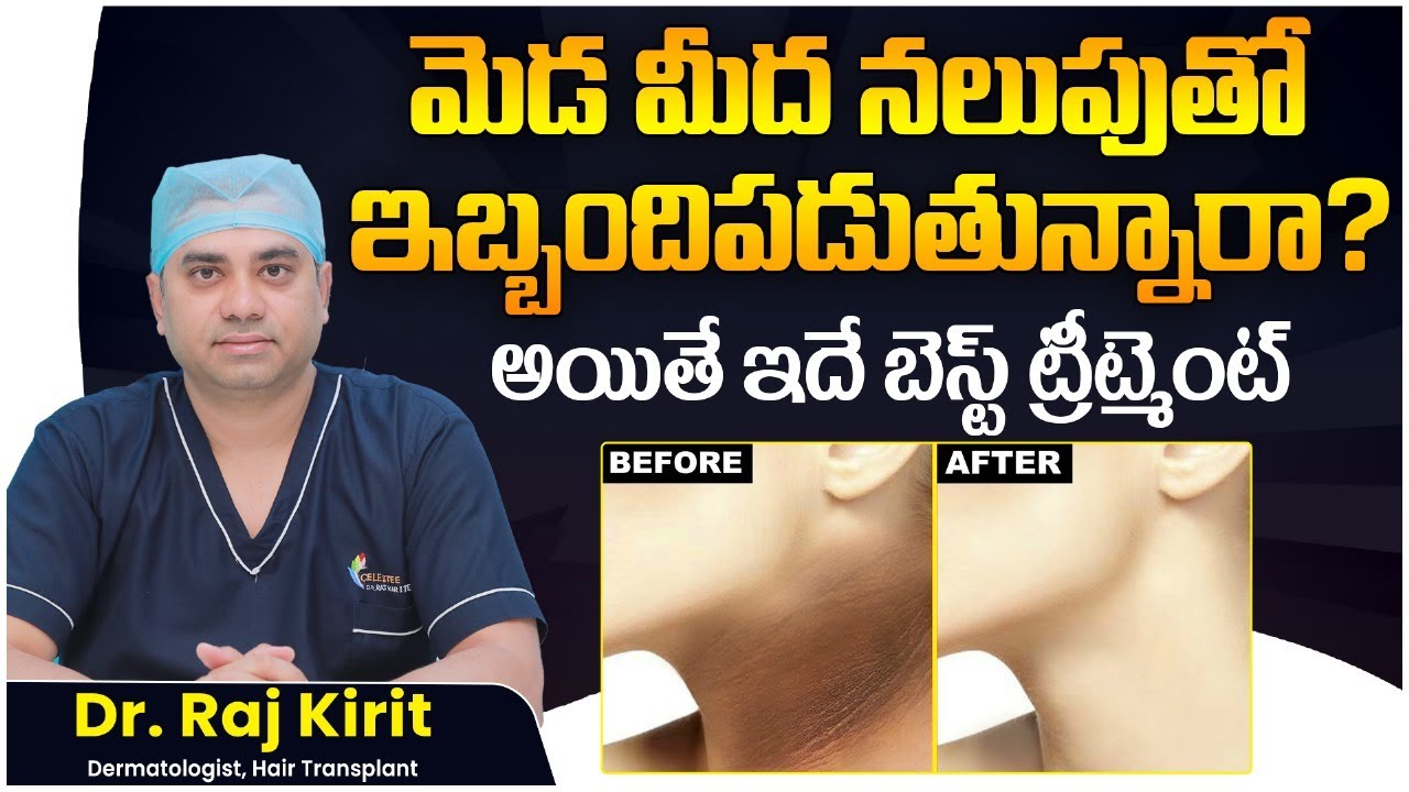 How to Get Rid of Acanthosis Nigricans on the Neck || Dark Neck Causes and Treatment || Celestee