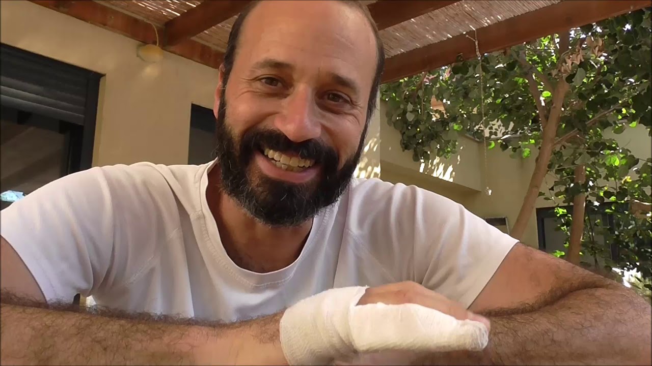 שברתי אצבע - הזדמנות לדבר על קיבועים