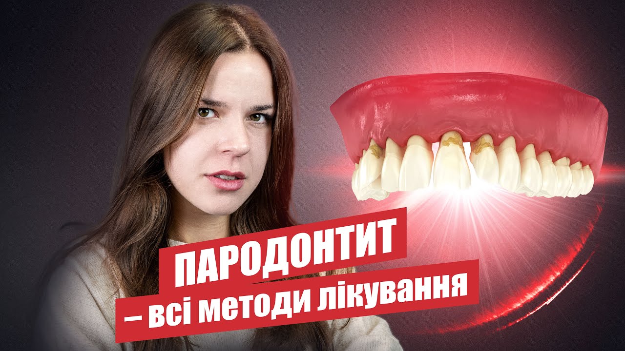 🇺🇦 Пародонтит. Методы лечения.