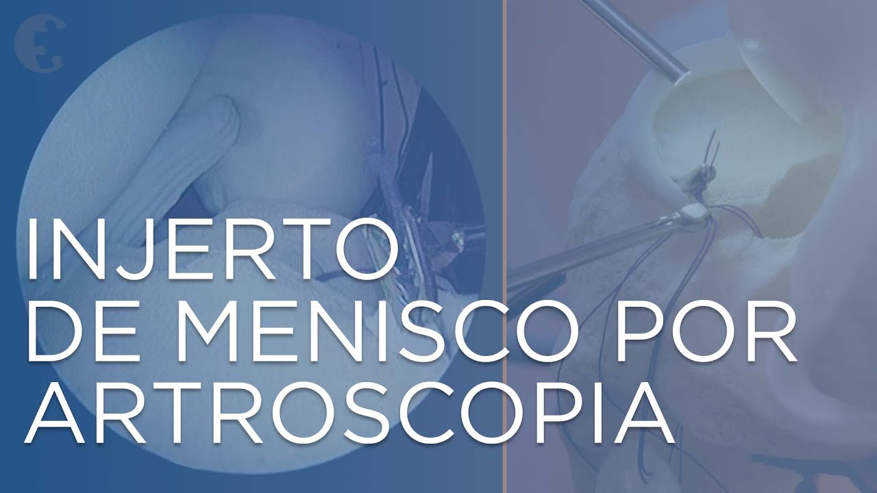 ¿Cómo se opera un menisco?  I Injerto de menisco por artroscopia