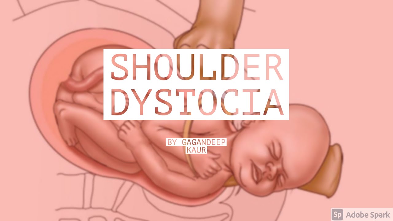SHOULDER DYSTOCIA(Unit-8 OBG- Abnormal Labour)