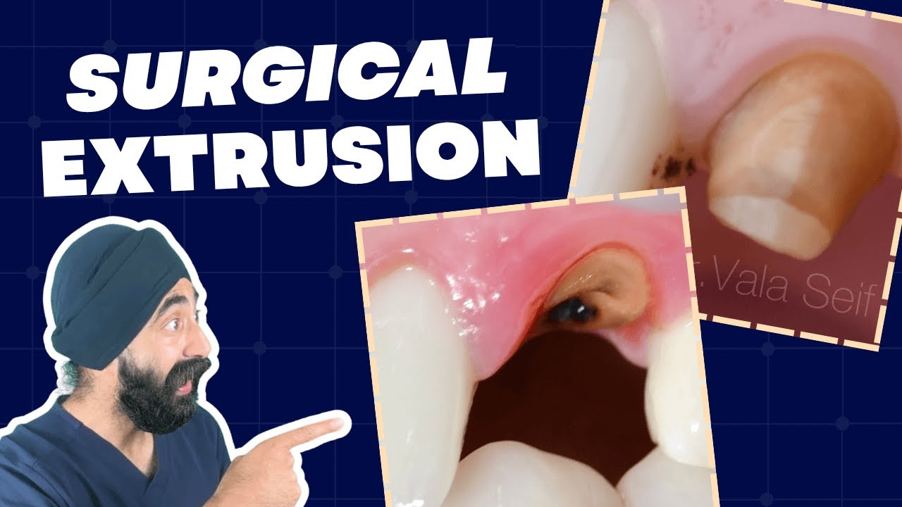 Surgical Extrusion Technique Update - Alternative to Ortho Extrusion or CLS - PDP249