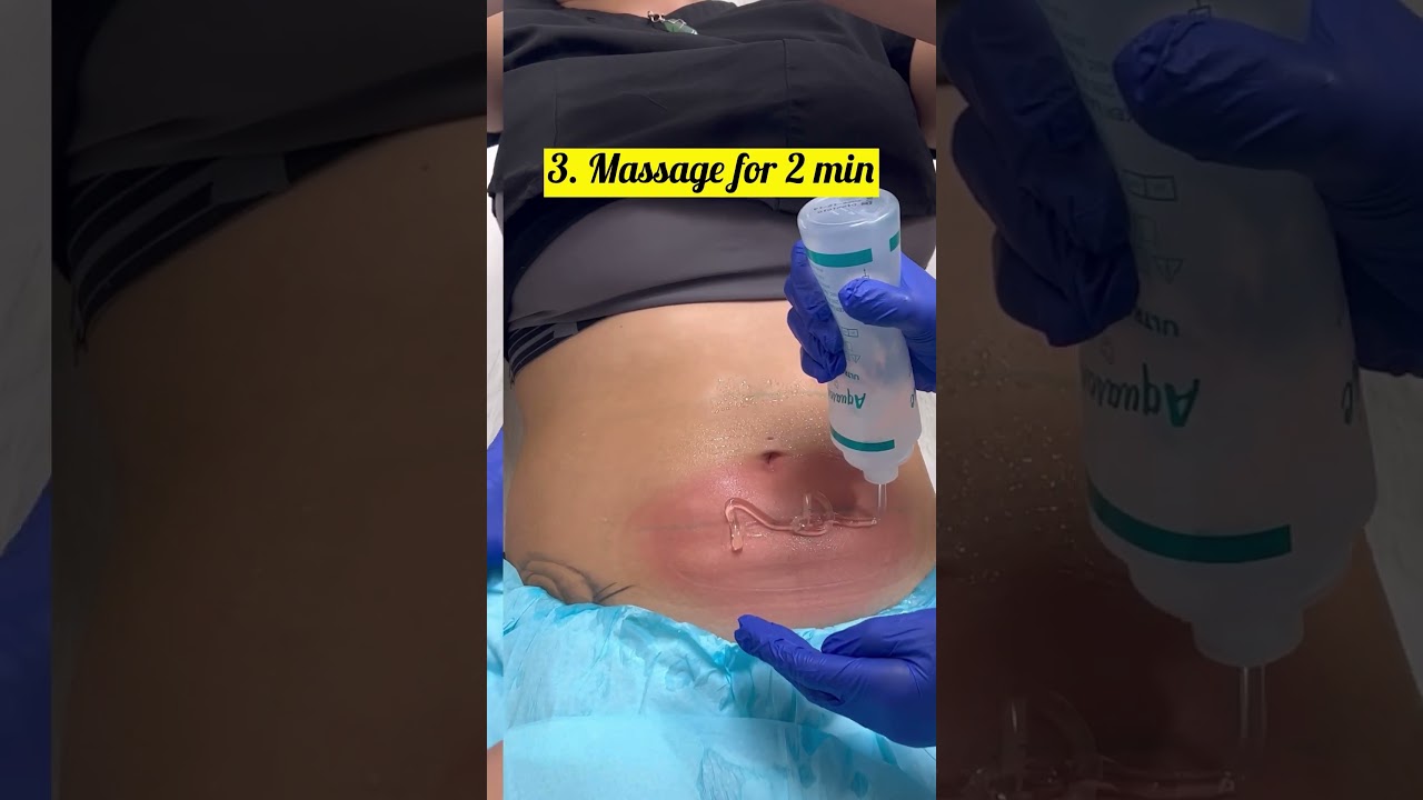 How to Lose Belly Fat without Surgery - Coolsculpting | Dr. Swati Kannan #shorts