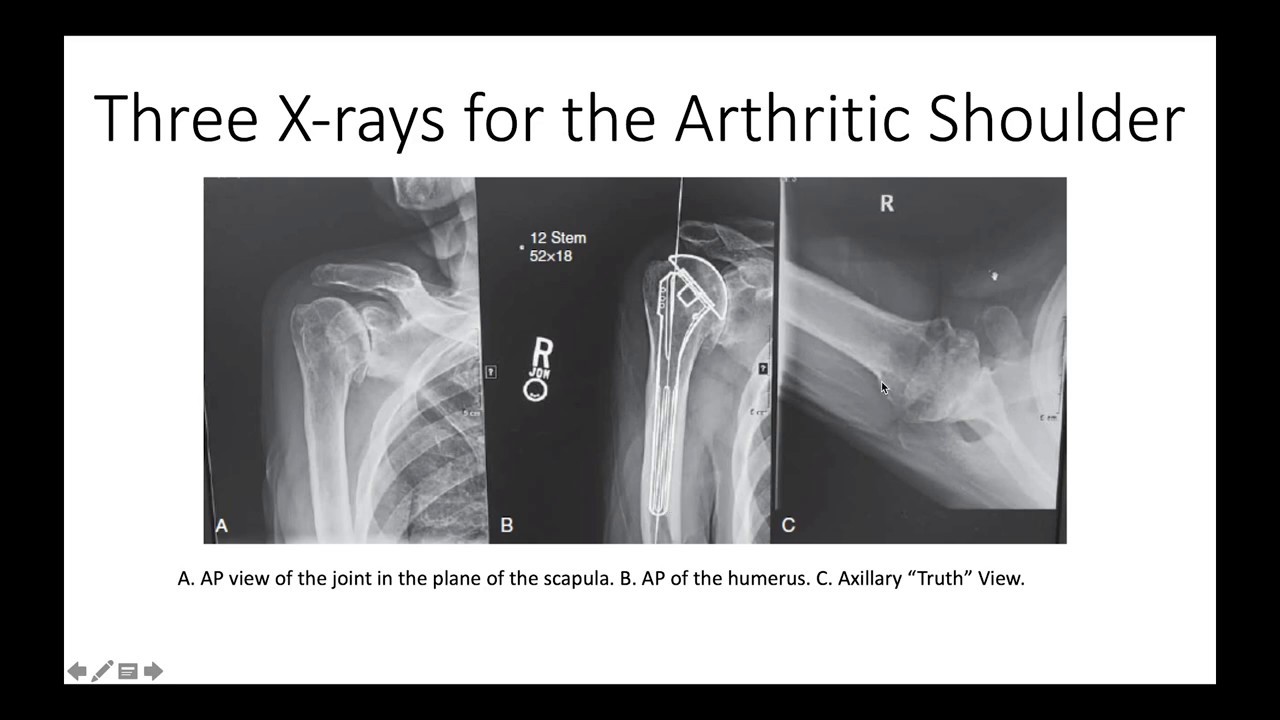 X Raying the Arthritic Shoulder: What You Need to Know