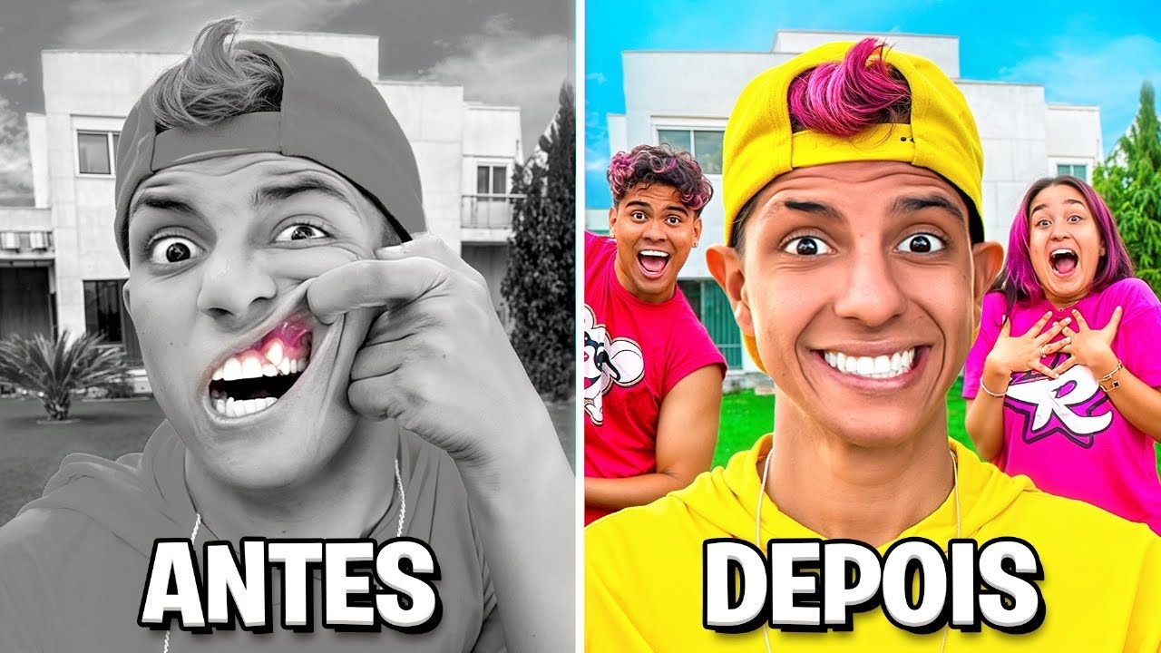 FIM DO MEU DENTE TORTO … *Fiz a cirurgia ?