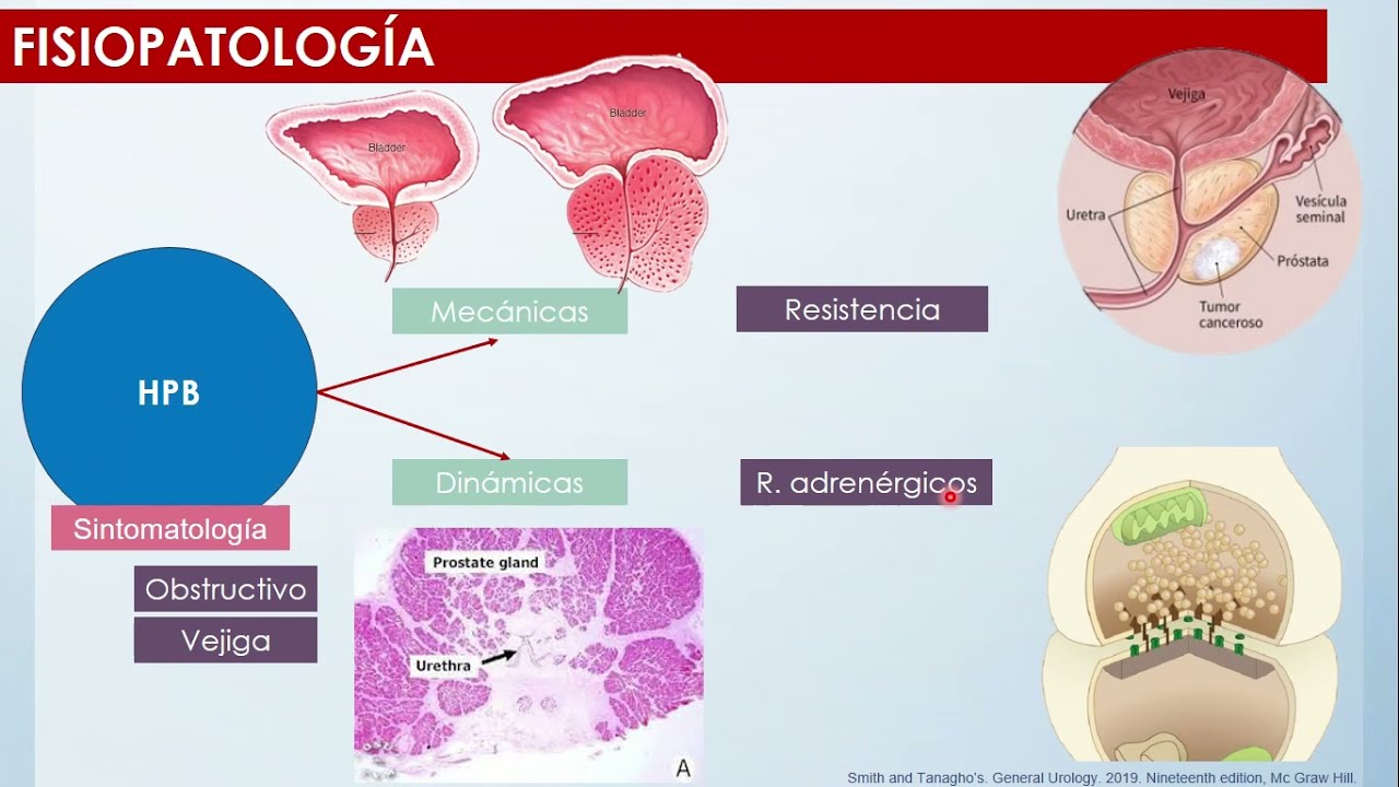 Hiperplasia prostática benigna patología y fisiopatología