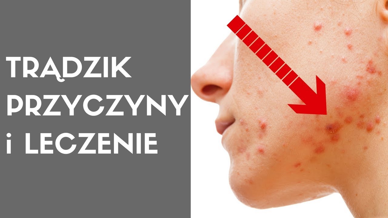 Dermatolog o trądziku. TRĄDZIK - przyczyny i leczenie.