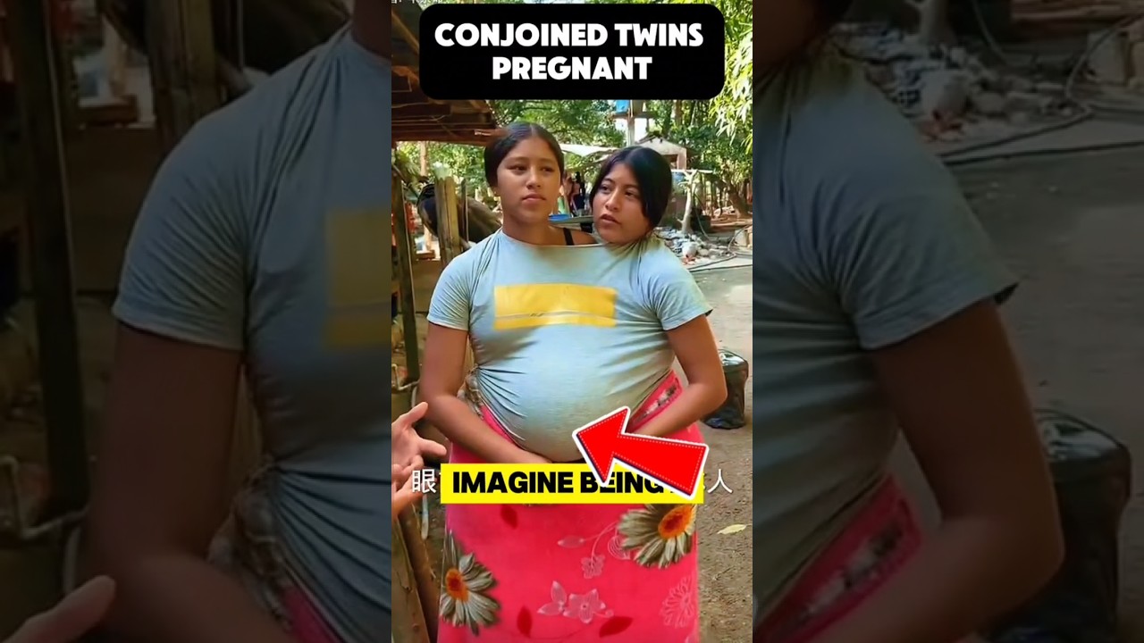 The conjoined twins pregnant #ConjoinedTwins #UniqueBond #InspiringStories