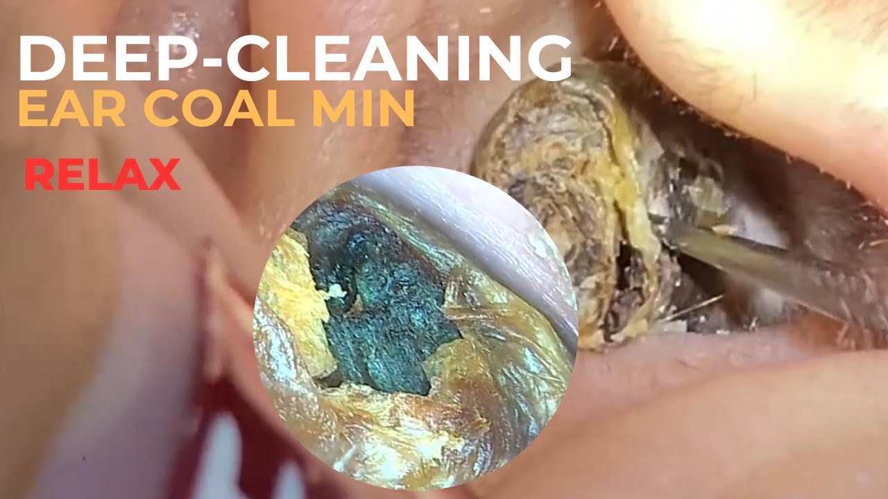 Earwax as Big as a Coal Mine &ndash; Extreme Ear Cleaning -ARMR