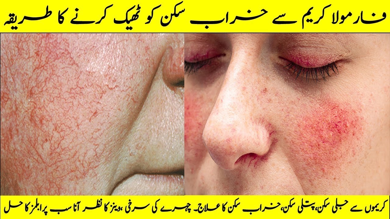 Formula cream se kharab skin ka Ilaj  ll How to treat 