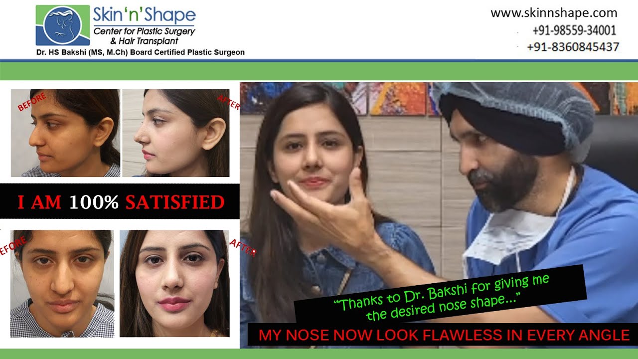 Rhinoplasty in India - Satisfied Client Testimonial - Skin n Shape - Dr. HS Bakshi +91-9855934001
