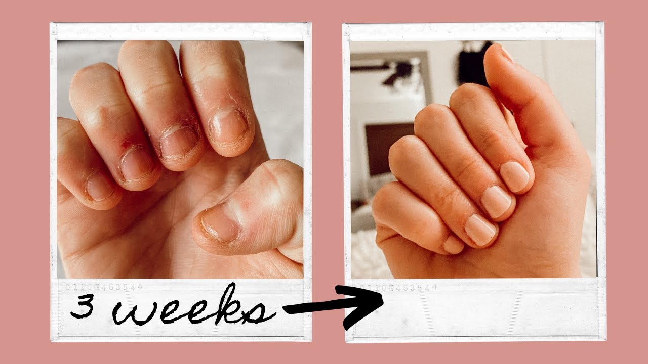 How to Stop Biting Your Nails for GOOD! What Finally Worked💅